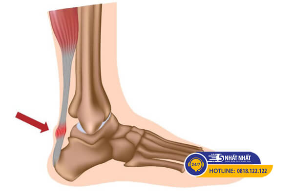 viêm gân achilles gây đau cổ chân khi chạy