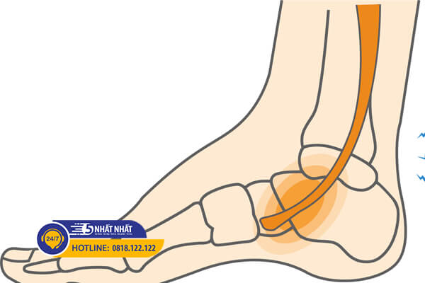 viêm gân chày sau gây đau cổ chân khi chạy bộ