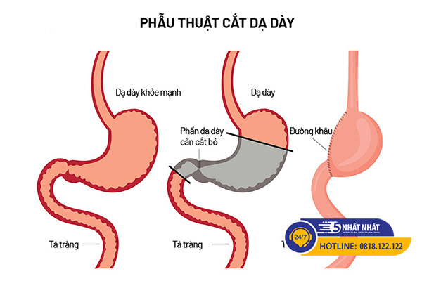 các phương pháp mổ viêm loét dạ dày