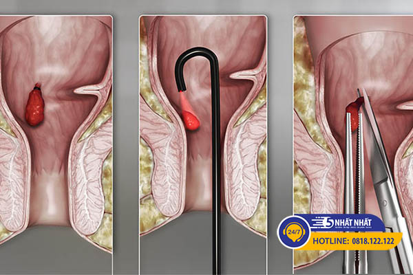 Các phương pháp ngoại khoa chữa bện trĩ giai đoạn 3 và 4