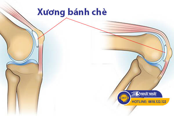 hội chứng xương bánh chè gây đau gối khi ngồi xổm