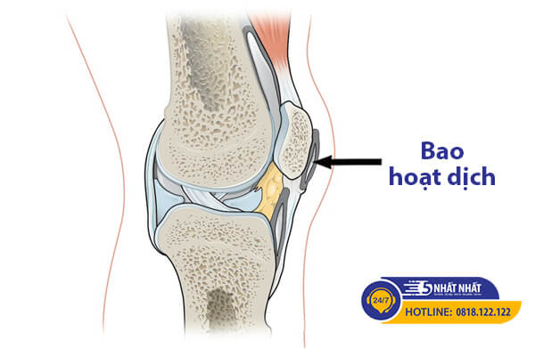 viêm bao hoạt dịch gây đau gối khi ngồi xổm