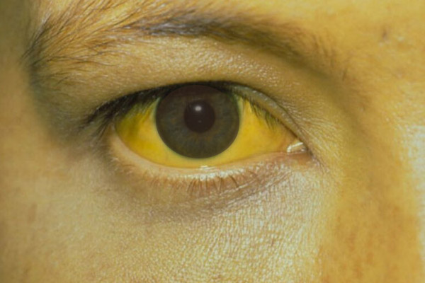 Vàng da, vàng mắt là dấu hiệu của chức năng gan kém