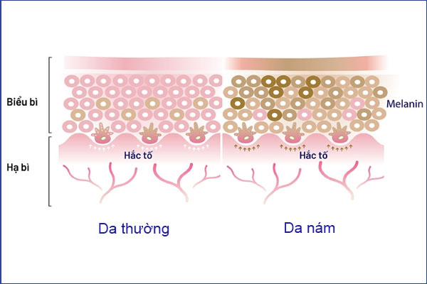 Nám nội tiết là gì