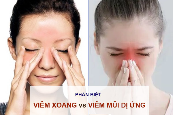 Phân biệt viêm xoang và viêm mũi dị ứng qua bản chất, triệu chứng bệnh...