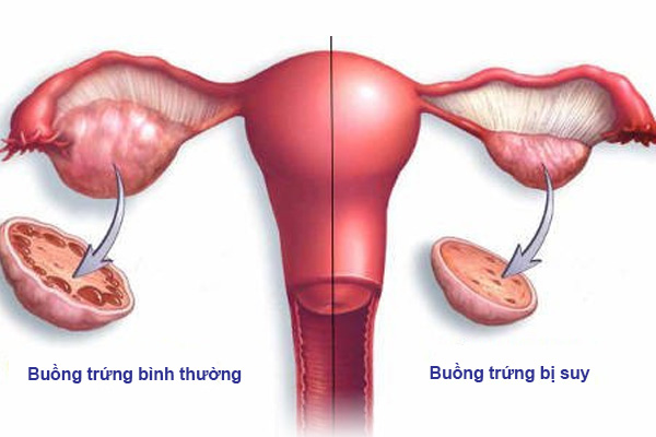 Dấu hiệu mãn kinh sớm