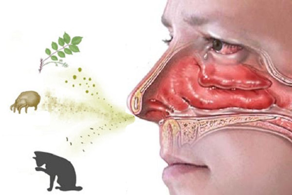 Ngứa mũi do viêm mũi dị ứng còn kèm theo các triệu chứng như hắt hơi, sổ mũi, chảy nước mắt...