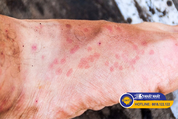 Côn trùng cắn gây mẩn đỏ ngứa ở chân