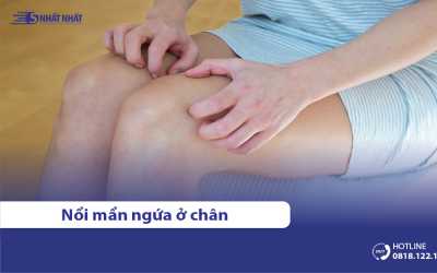 7 Nguyên nhân gây nổi mẩn ngứa ở chân & Cách giảm ngứa hiệu quả