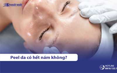 Peel da có trị nám được không?