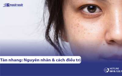 Tàn nhang là gì? Nguyên nhân gây ra & Cách điều trị hiệu quả