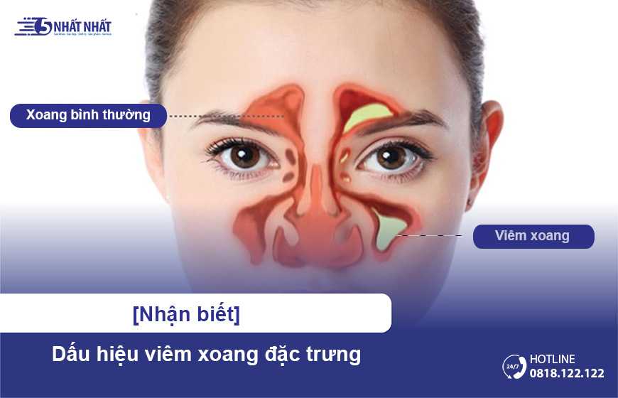 [Nhận biết] Dấu hiệu điển hình của bệnh viêm xoang mũi