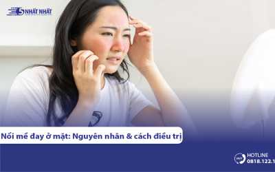 Nổi mề đay trên mặt: Nguyên nhân & Cách khắc phục hiệu quả