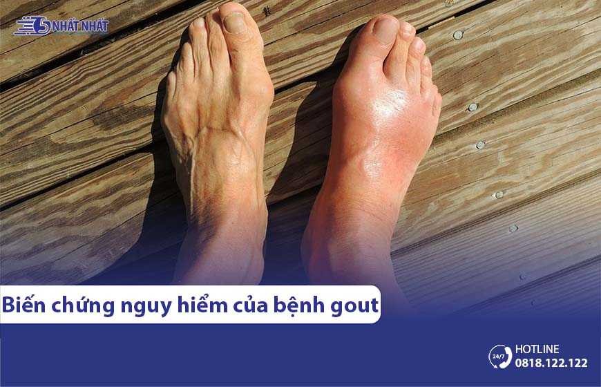 Cảnh giác với 9 biến chứng nguy hiểm của bệnh Gout (gút)