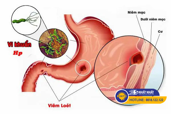 viêm dạ dày hp là gì