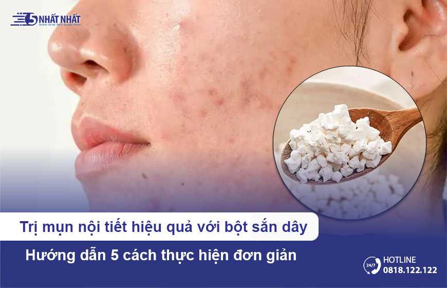 Trị mụn nội tiết hiệu quả với bột sắn dây: 5 cách dùng đơn giản