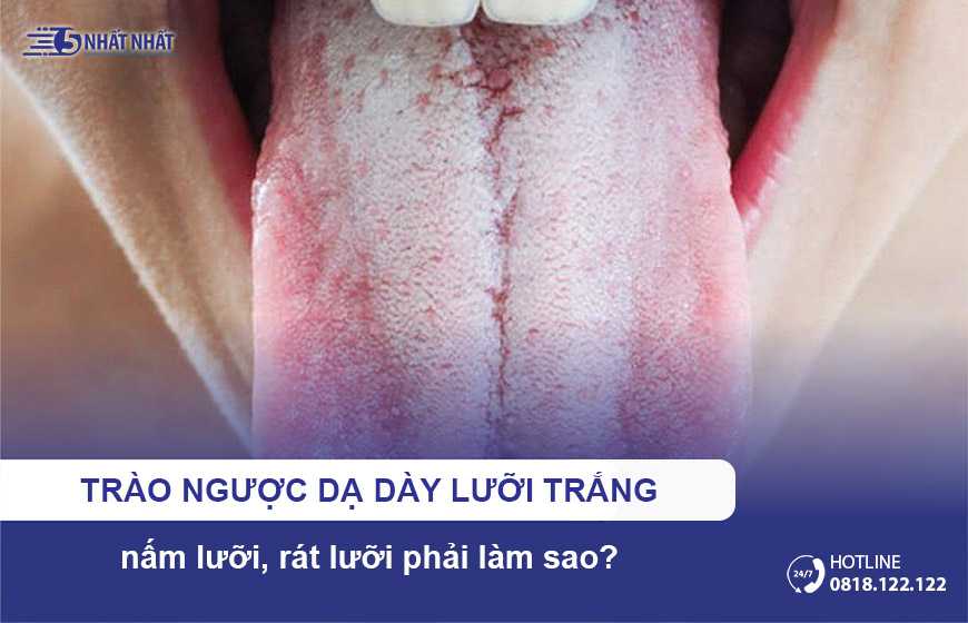Trào ngược dạ dày lưỡi trắng, nấm lưỡi, rát lưỡi phải làm sao?