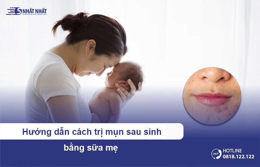 Trị mụn sau sinh bằng sữa mẹ - Hướng dẫn chi tiết