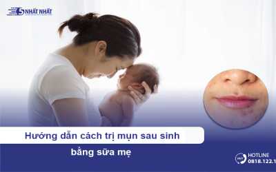 Hướng dẫn cách trị mụn sau sinh bằng sữa mẹ