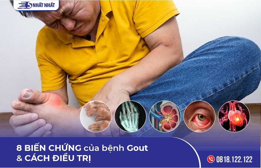 8 Biến chứng của bệnh Gout & Cách điều trị