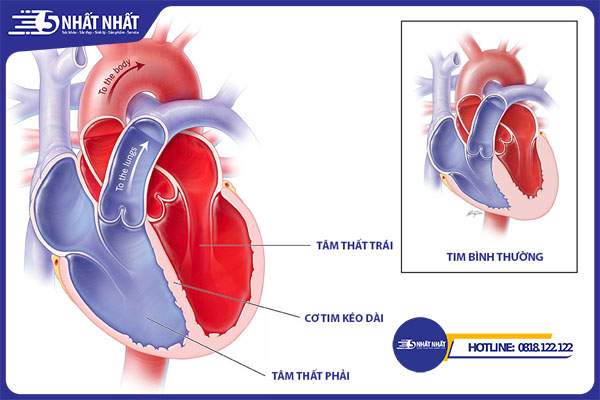 bệnh cơ tim do rượu bia