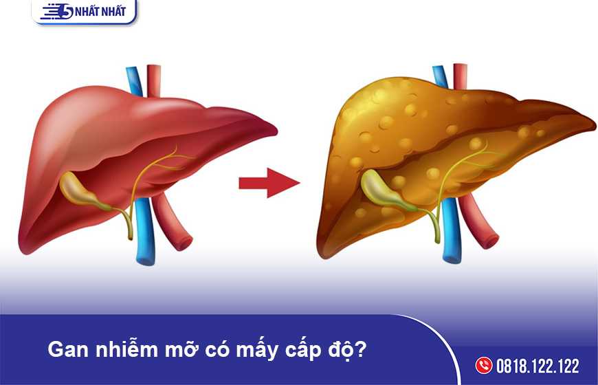 Gan nhiễm mỡ có mấy cấp độ? Phân biệt bằng cách nào?