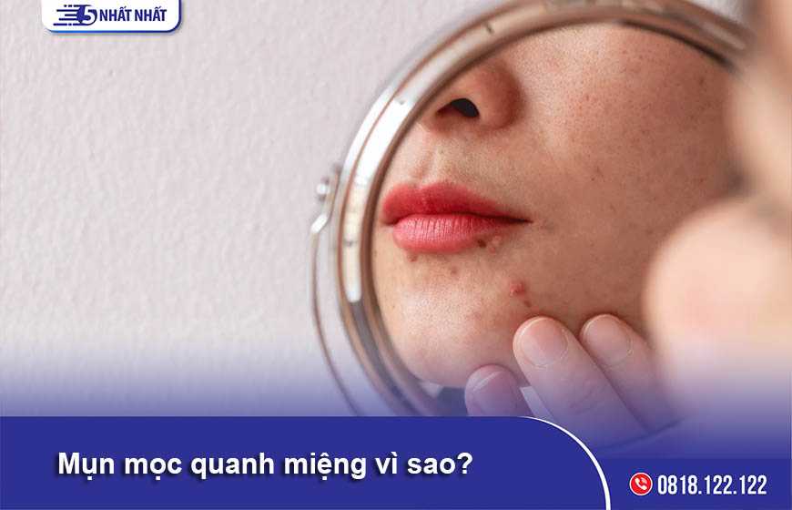 Mụn mọc quanh miệng vì sao? Chữa bằng cách nào?