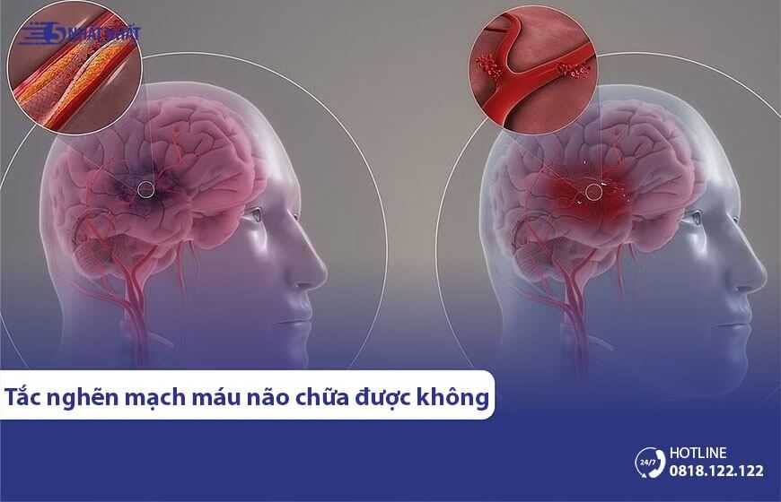 Tắc nghẽn mạch máu não có chữa & phục hồi được không?