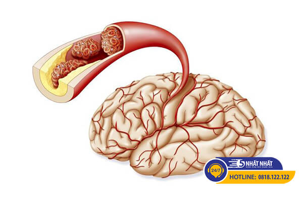 Thiểu năng tuần hoàn não là bệnh gì?