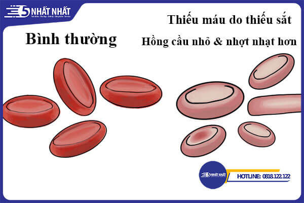 thiếu máu do thiếu sắt là như thế nào